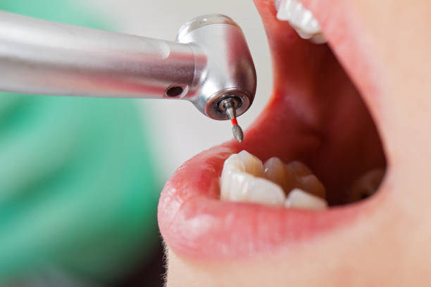 Best Emergency Root Canal Treatment in K I Sawyer, MI